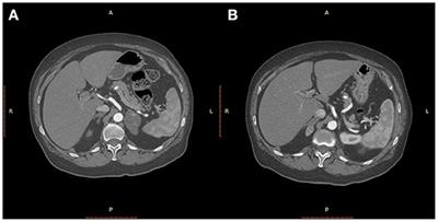 Results of Adrenalectomy for Isolated, Metachronous Metastasis of Breast Cancer: A Retrospective Cohort Study